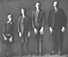 Die drei Personen von links leiden am Marfan-Syndrom.