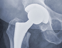 Röntgenbild von Hüftgelenk-Implantat