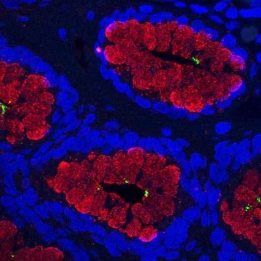 Mikroskopische Aufnahme von einem Gewebsschnitt von einem menschlichen Magen mit Helicobacter pylori Infektion. Blau markierte Zellkerne, Rot markierter Schleim, der in den Grübchenzellen gebildet wird, Grün markiert Helicobacter pylori. 