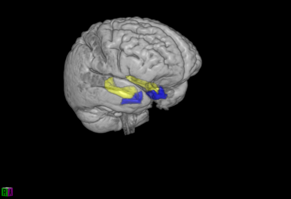 3D-Visualisierung des Gehirns mit farbiger Markierung des Hippocampus.