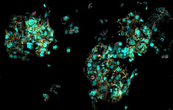 Organoid aus Brustkrebszellen: Zusammenhängende, leuchtende Punkte vor schwarzem Hintergrund