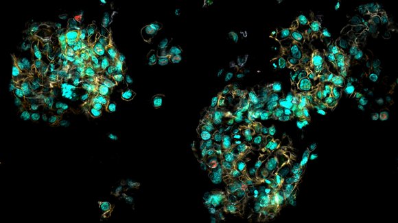 Organoid aus Brustkrebszellen: Zusammenhängende, leuchtende Punkte vor schwarzem Hintergrund